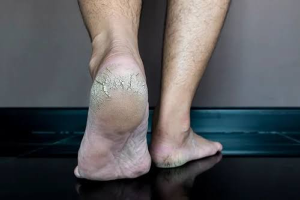Rachaduras nos Pés